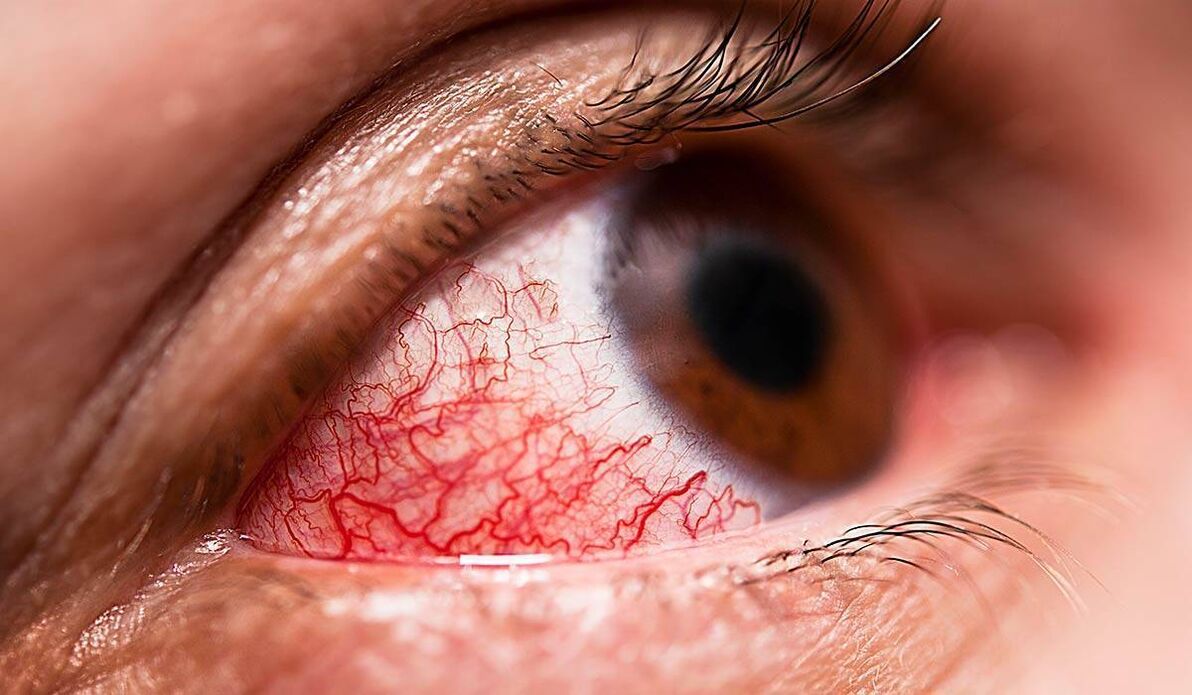 Diabetinė retinopatija yra viena iš vėlyvųjų diabeto komplikacijų